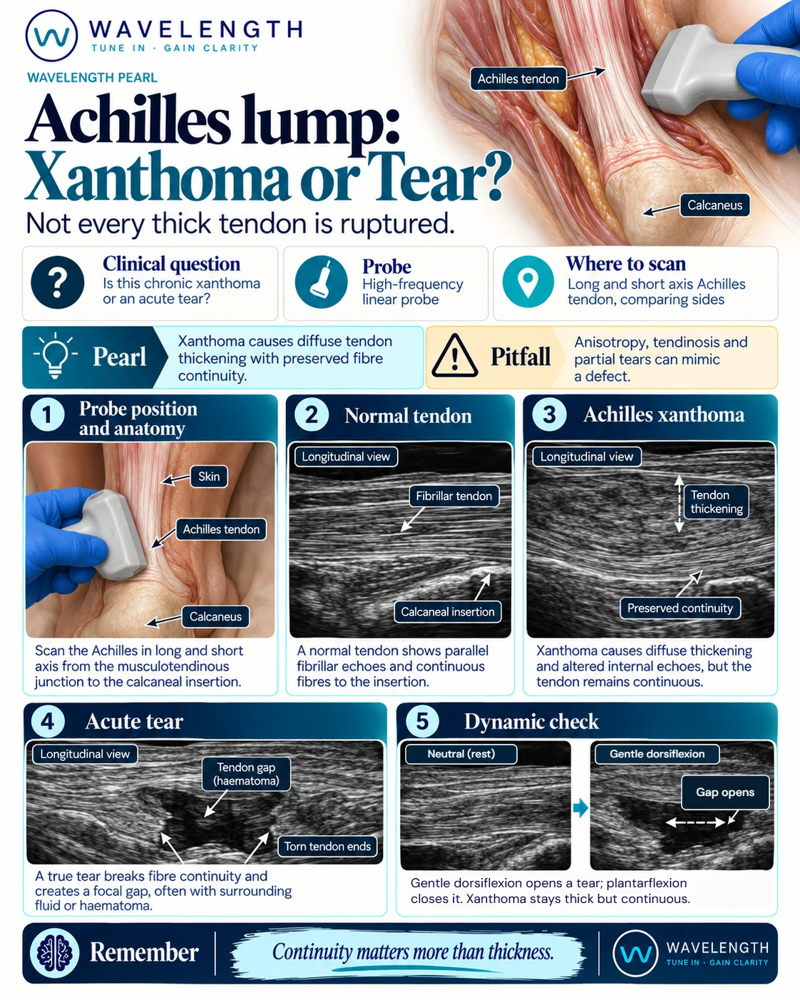 Wavelength Pearl: Achilles lump. A xanthoma thickens the tendon with continuous fibres. A tear leaves a gap which opens with gentle dorsiflexion.