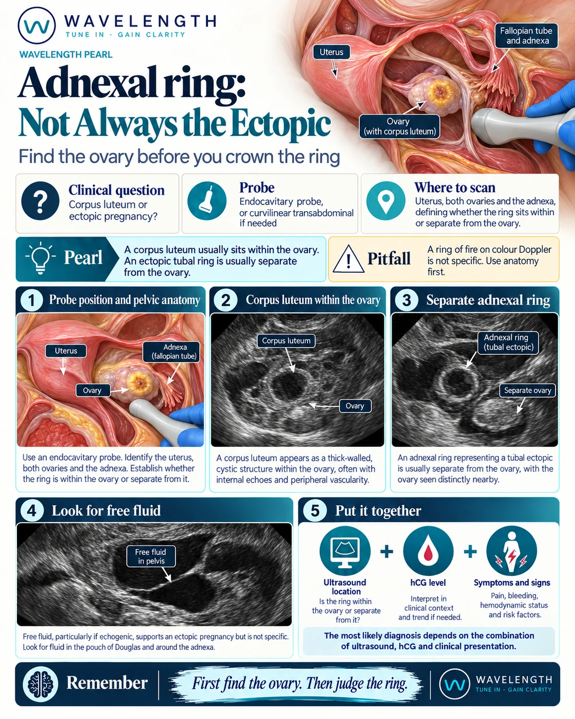 Wavelength Pearl: adnexal ring. A corpus luteum within the ovary, and a separate tubal ring beside the ovary.