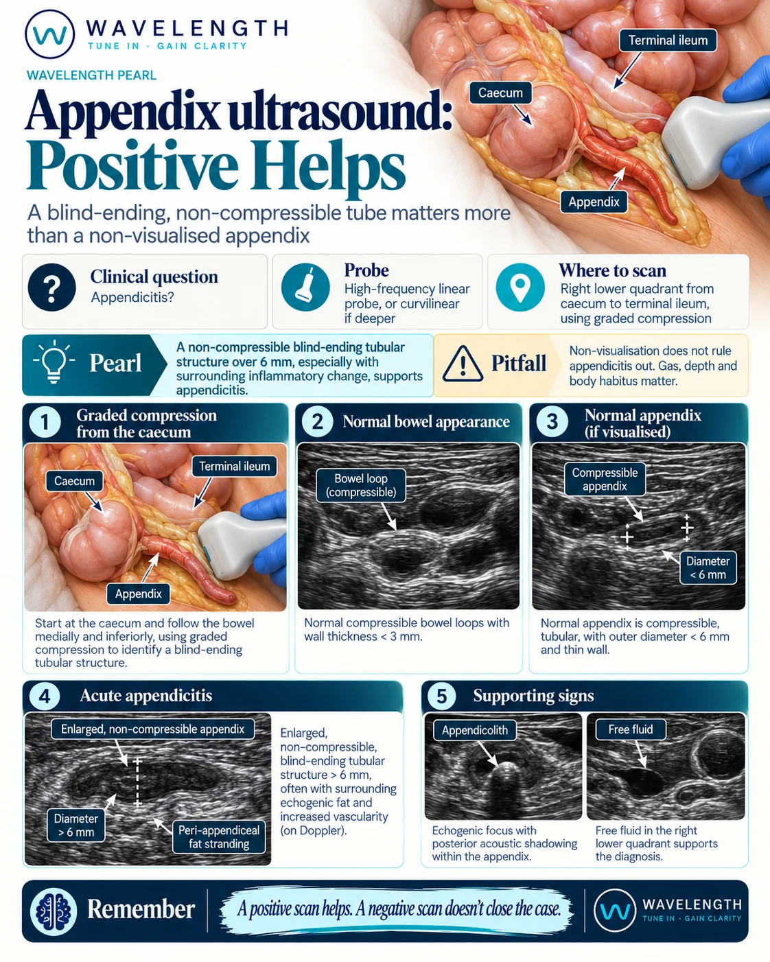 Wavelength Pearl: appendix ultrasound. Use graded compression from the caecum, and look for a blind-ending, non-compressible tube over 6 mm.