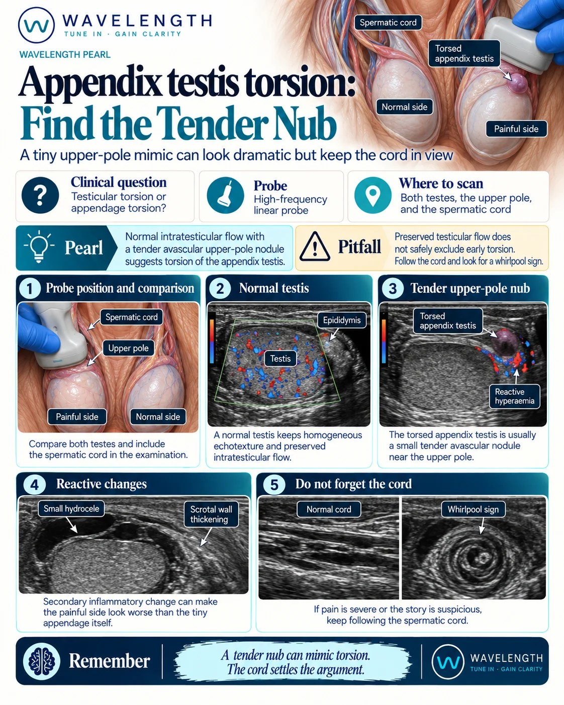 Wavelength Pearl: torsion of the appendix testis. A tender, avascular nodule at the upper pole beside a testis with normal flow. Follow the cord.