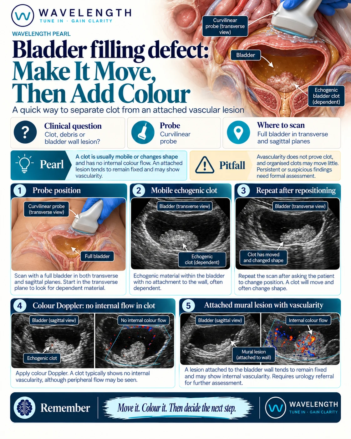 Wavelength Pearl: bladder filling defect. Reposition the patient to see if it moves, then use colour Doppler to look for internal flow.