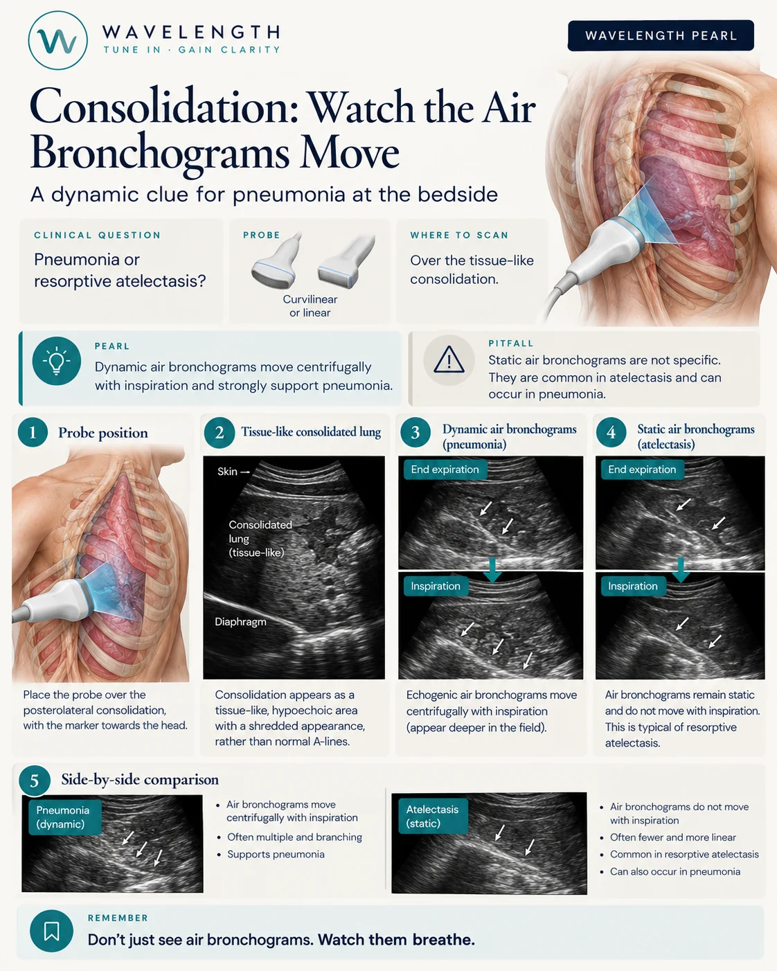 Wavelength Pearl: consolidation. Dynamic air bronchograms move with inspiration and support pneumonia.