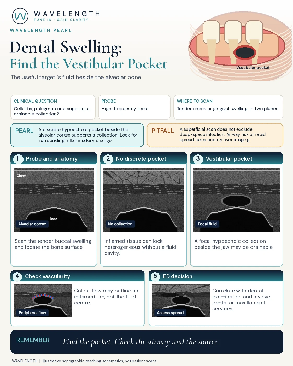 Wavelength Pearl: dental swelling. Cheek soft tissue over the alveolar bone, oedema without a collection, and a focal pocket beside the bone with flow in its rim.