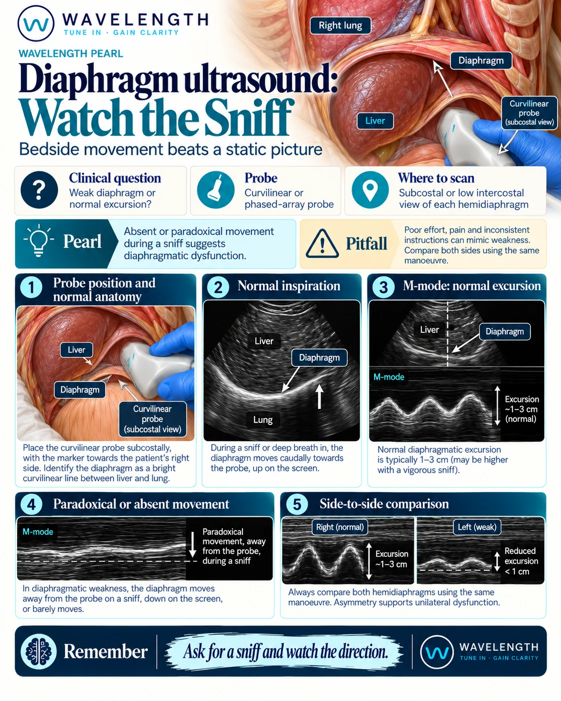 Wavelength Pearl: diaphragm ultrasound. On a sniff, the normal diaphragm moves towards the probe. A paralysed diaphragm moves away from it, or barely moves.