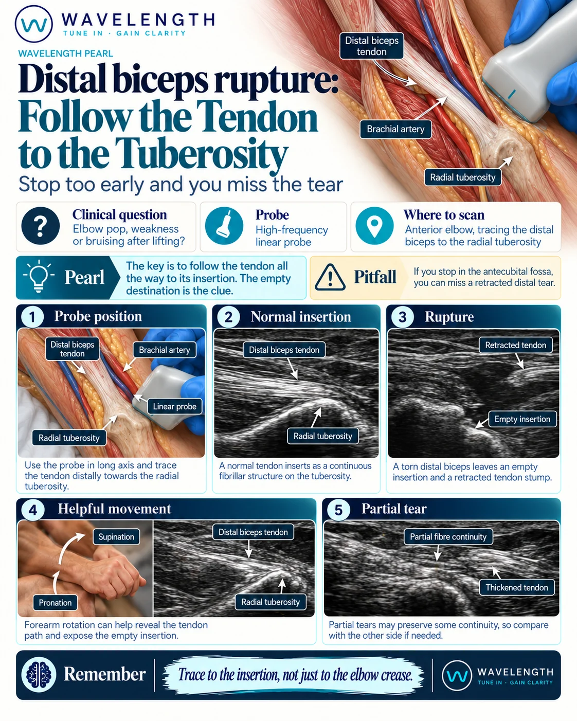 Wavelength Pearl: distal biceps rupture. Follow the tendon all the way to its insertion on the radial tuberosity. The empty insertion is the clue.