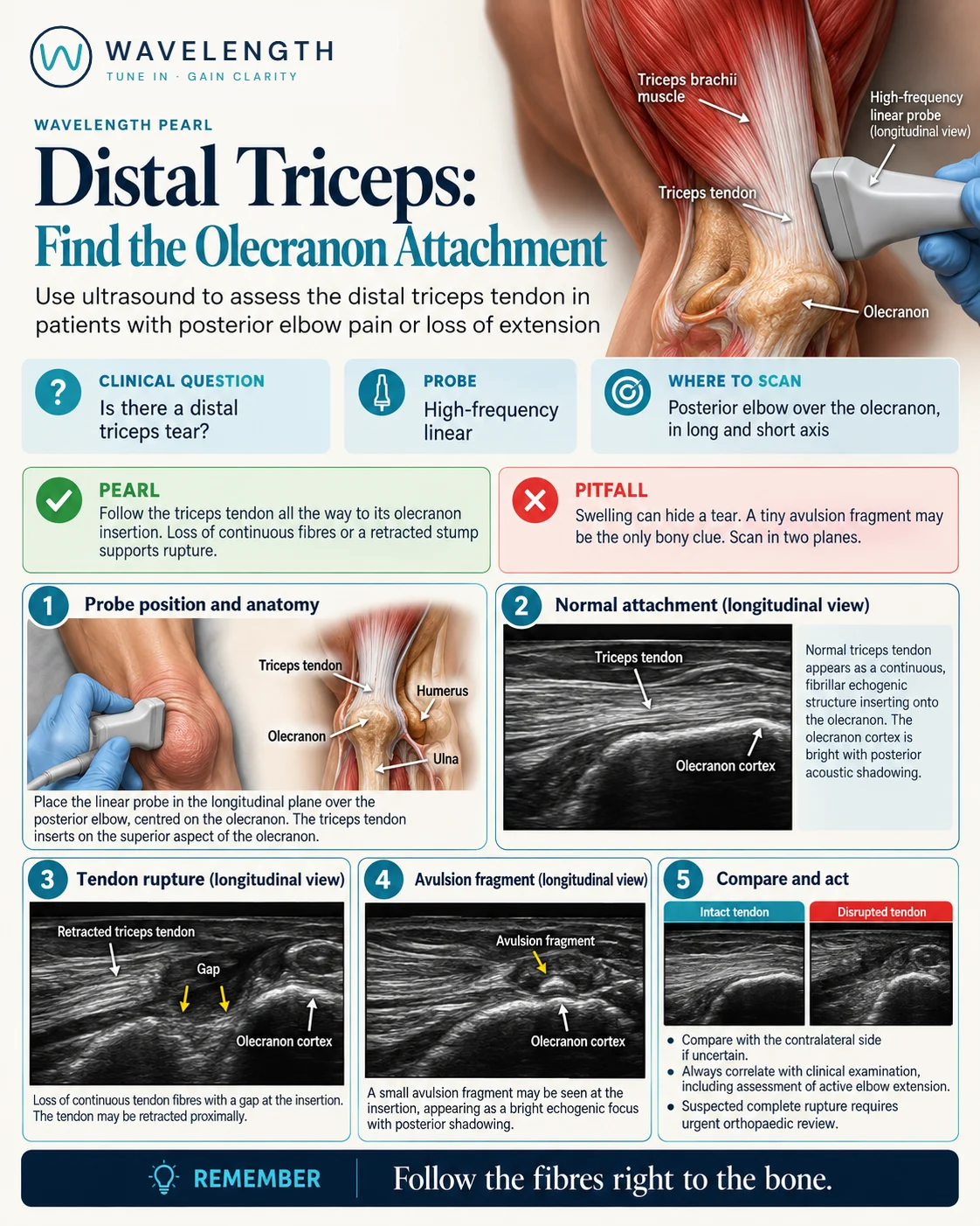 Wavelength Pearl: distal triceps. The normal tendon inserting on the olecranon, a rupture with a gap and a retracted tendon, and a small avulsion fragment.