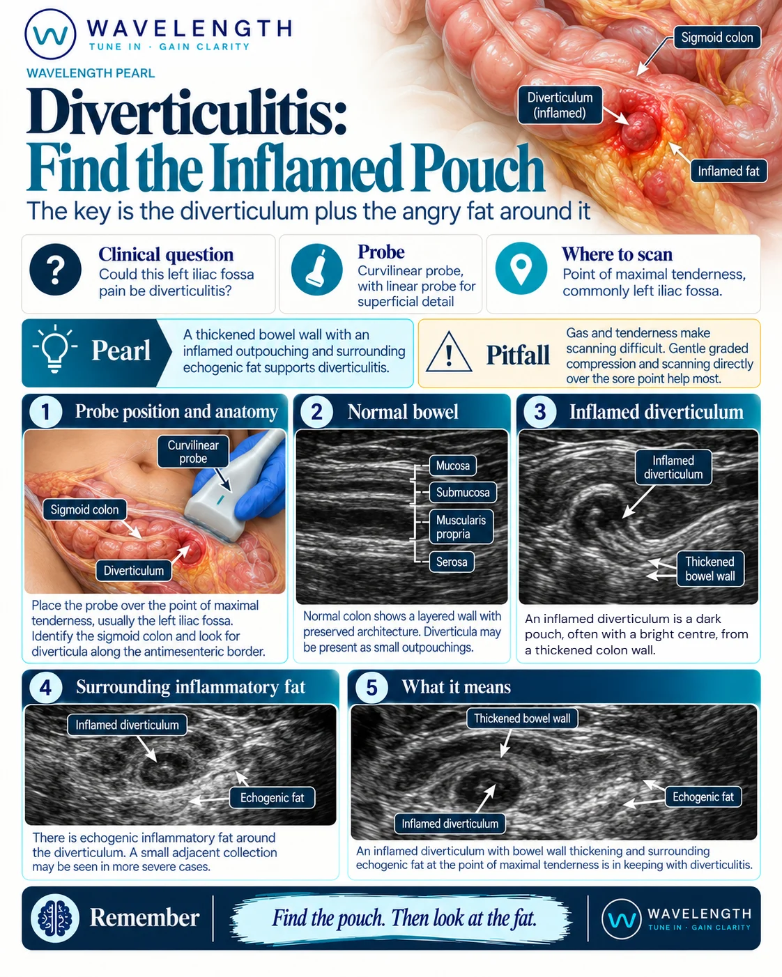 Wavelength Pearl: diverticulitis. A thickened colon wall, an inflamed diverticulum and bright inflamed fat at the point of tenderness.