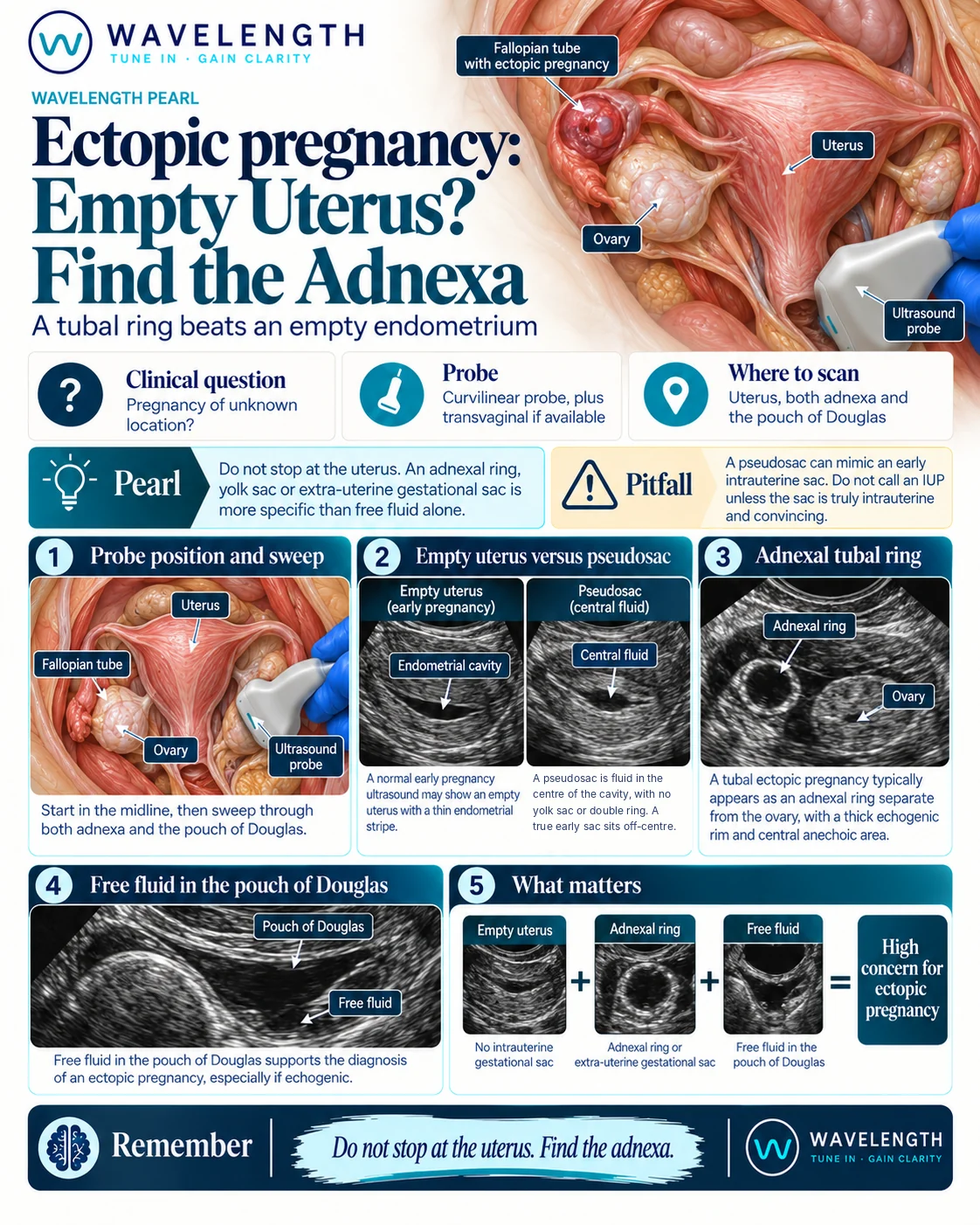 Wavelength Pearl: ectopic pregnancy. Look for an intrauterine pregnancy, then the adnexa and the pouch of Douglas.