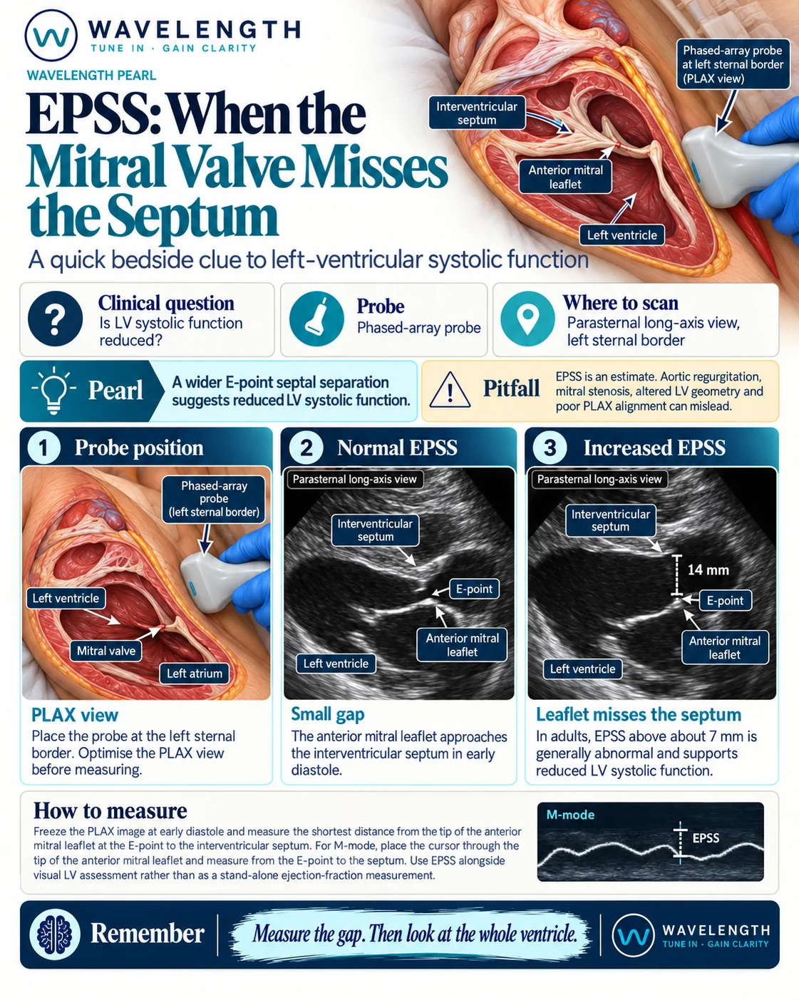 Wavelength Pearl: EPSS. In the parasternal long-axis view, measure the gap between the anterior mitral leaflet at the E-point and the septum.