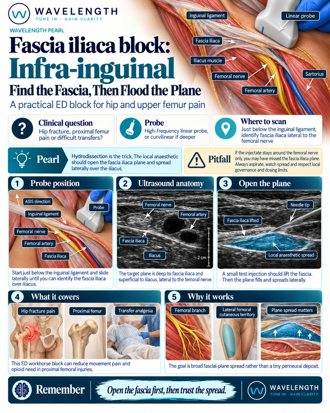 Wavelength Pearl: infra-inguinal fascia iliaca block. Find fascia iliaca over iliacus and hydrodissect the plane.