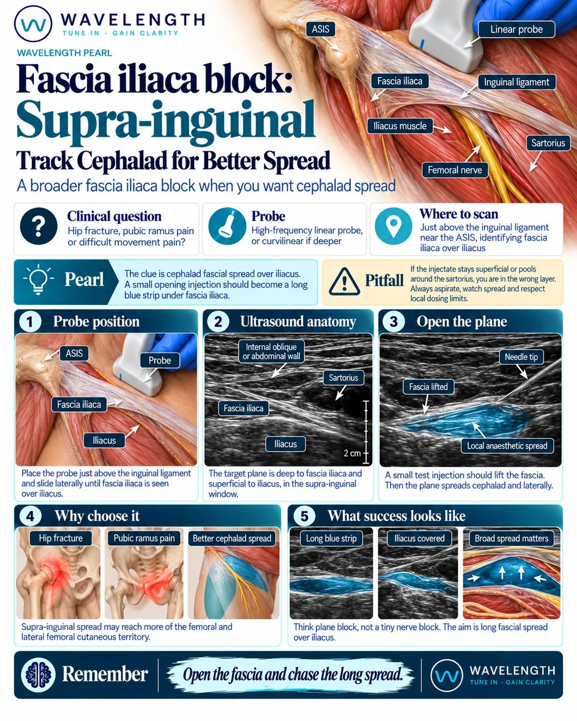 Wavelength Pearl: supra-inguinal fascia iliaca block. Track the spread towards the head under fascia iliaca over iliacus.