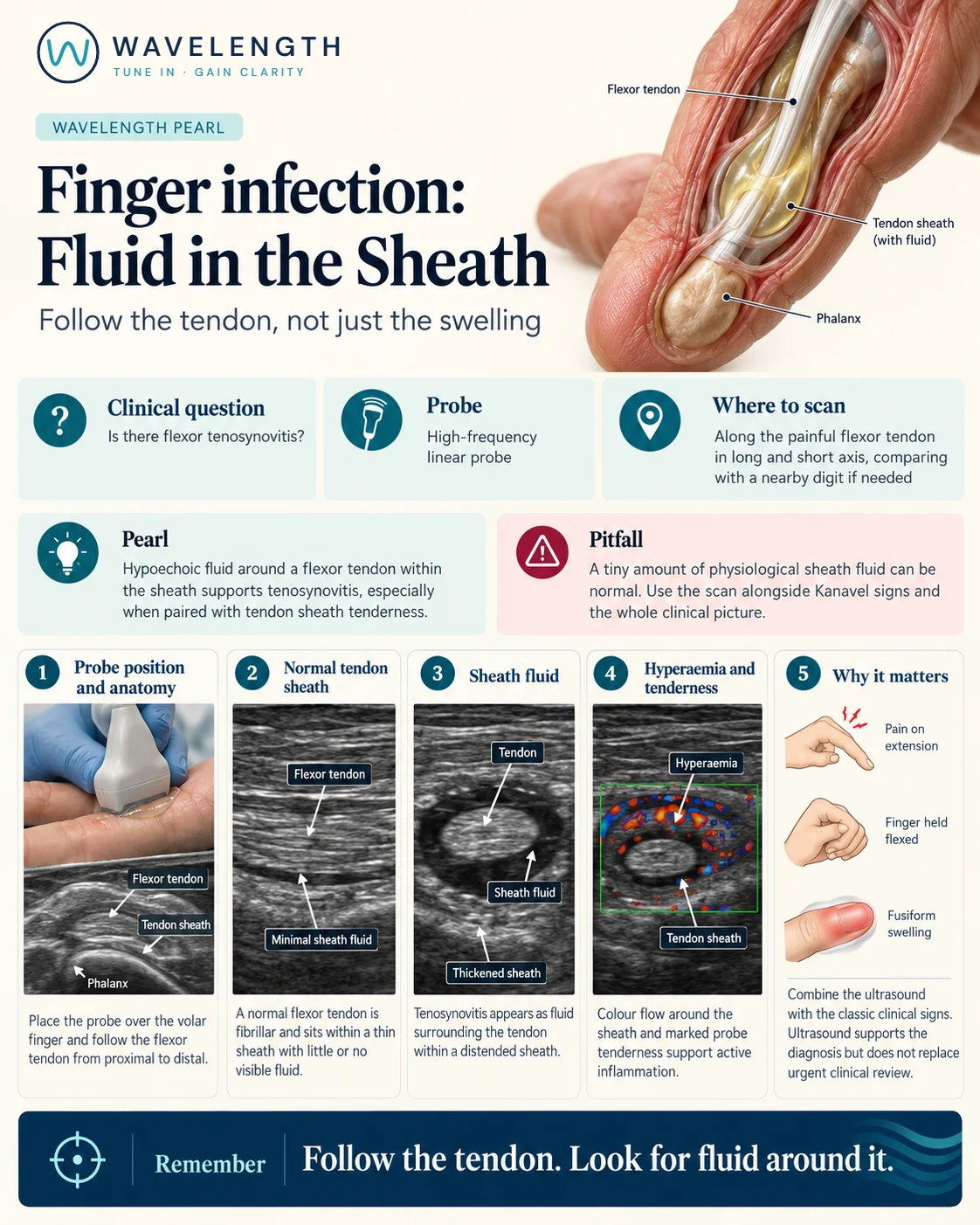 Wavelength Pearl: finger infection. A normal flexor tendon, fluid around the tendon in a distended sheath, and hyperaemia.