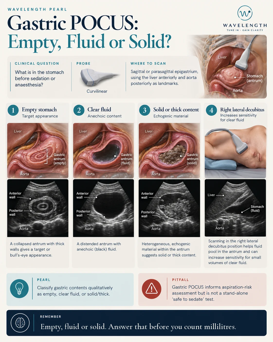 Wavelength Pearl: gastric POCUS. Classify the antrum as empty, clear fluid or solid.