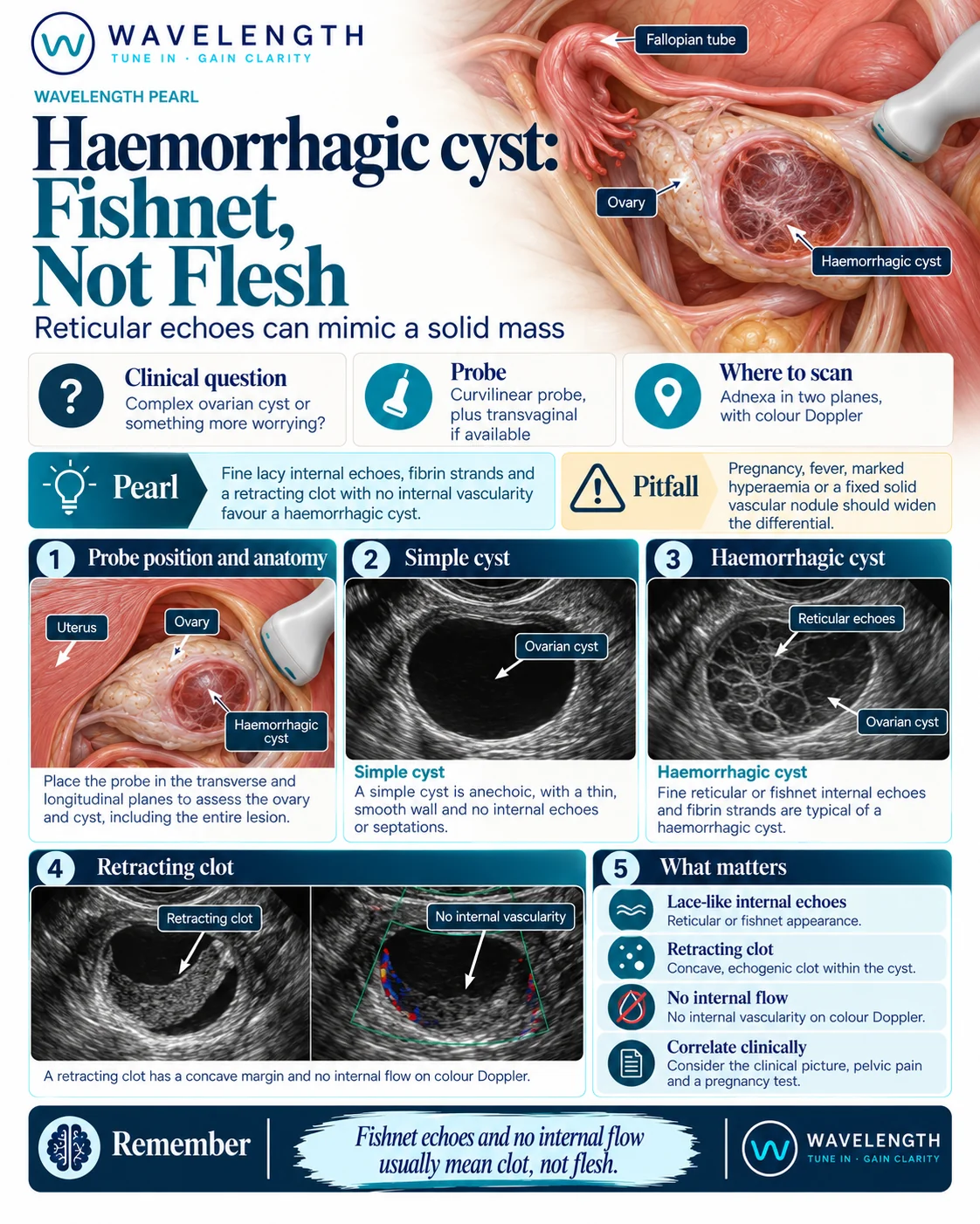 Wavelength Pearl: haemorrhagic cyst. Look for reticular fishnet echoes and a retracting clot with no internal flow.