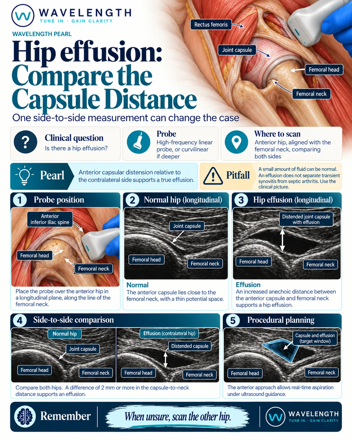 Wavelength Pearl: hip effusion. Align the probe with the femoral neck, measure the capsule-to-neck distance and compare both hips.