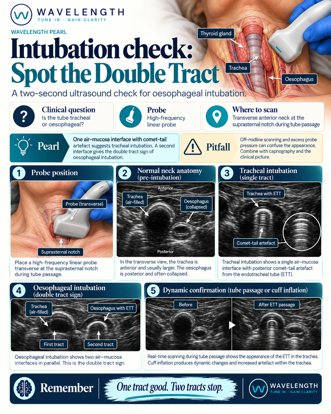 Wavelength Pearl: intubation check. One air-mucosa interface means tracheal intubation. A second interface beside the trachea, the double tract sign, means oesophageal intubation.