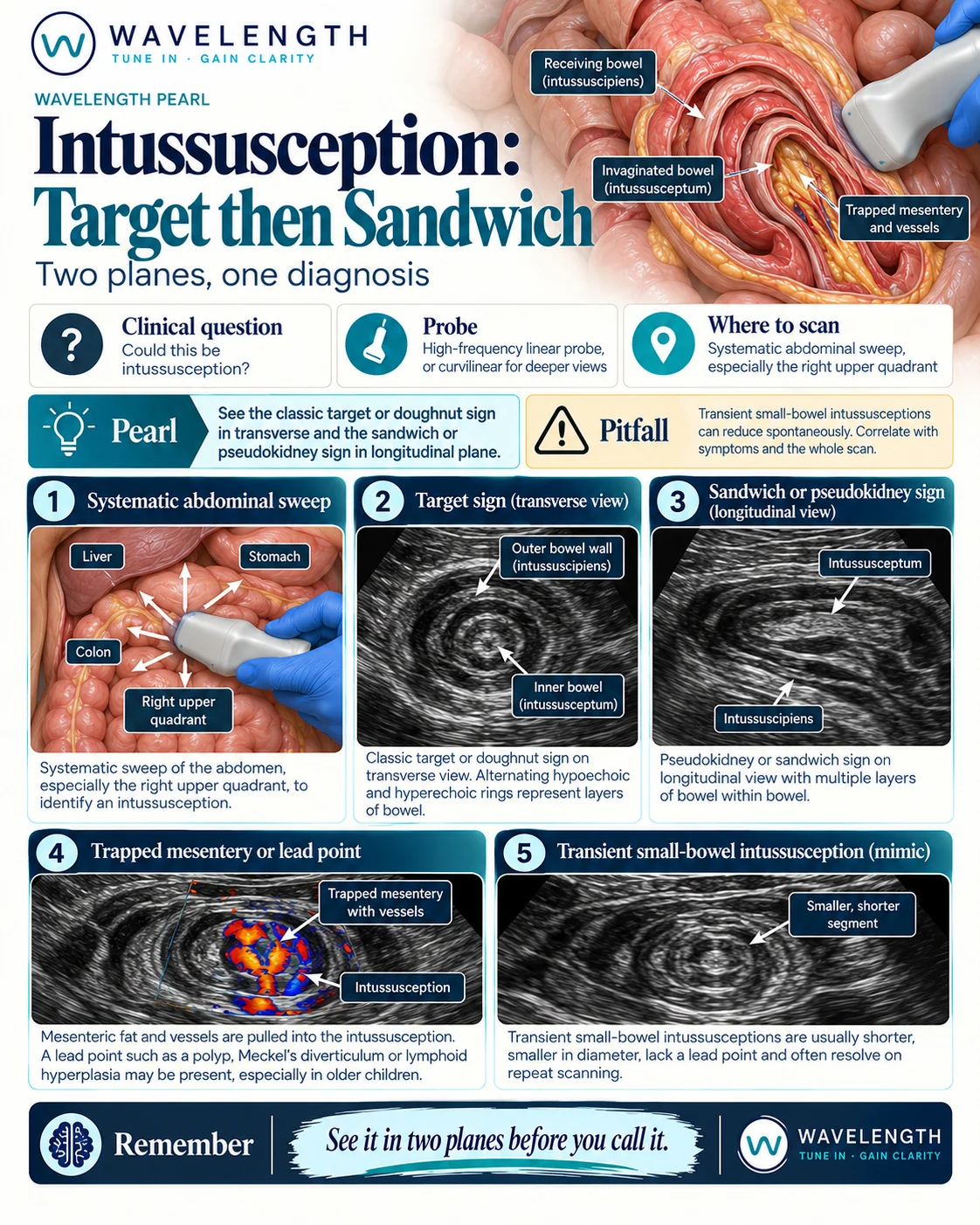 Wavelength Pearl: intussusception. A target sign in transverse and a sandwich or pseudokidney sign in long axis confirm the diagnosis.