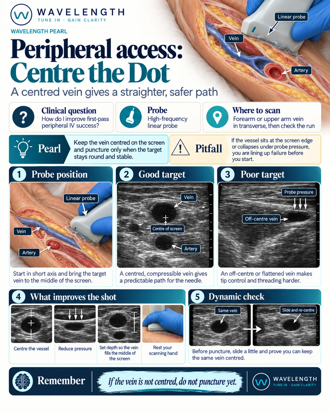 Wavelength Pearl: peripheral access. Centre the vein on the screen, keep it round and puncture only when it stays stable.