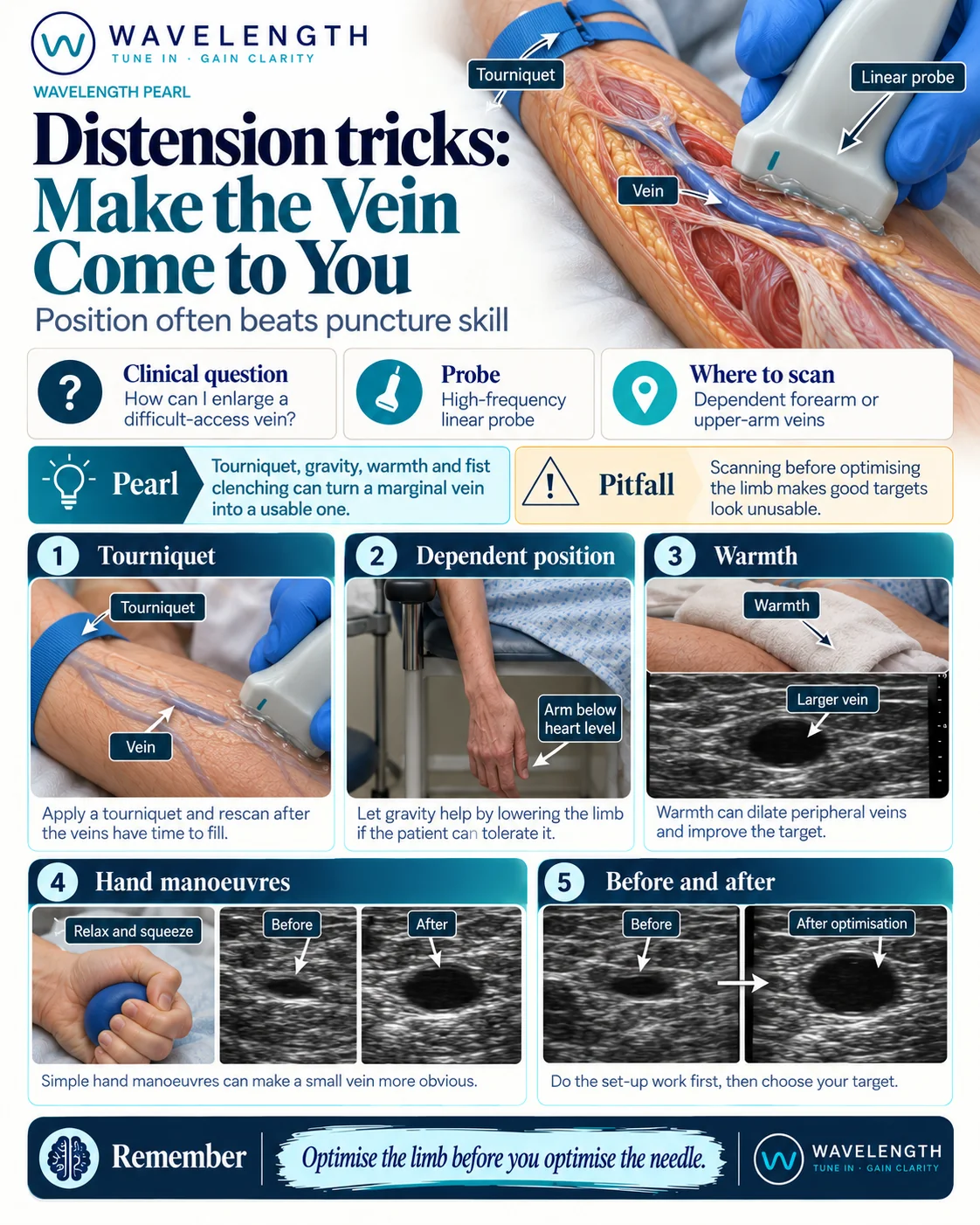 Wavelength Pearl: distension tricks. Tourniquet, dependent arm, warmth and hand squeezing enlarge a marginal vein before you choose a target.