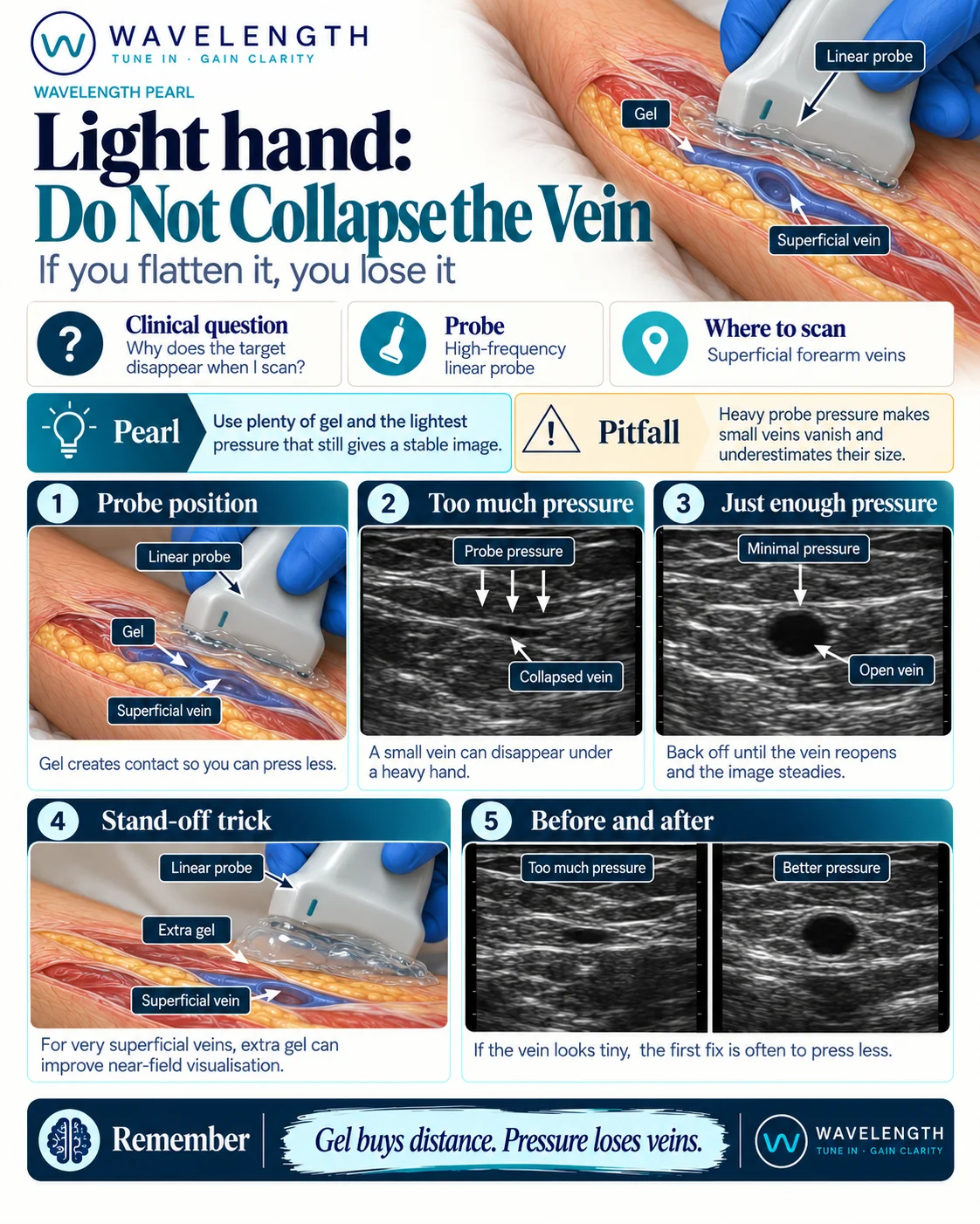 Wavelength Pearl: light hand. Use plenty of gel and the lightest pressure that gives a stable image, so the vein stays open.
