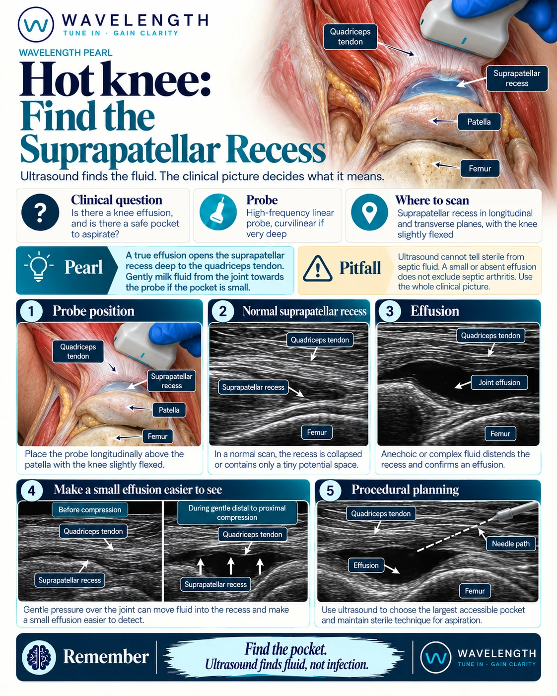 Wavelength Pearl: hot knee. Scan the suprapatellar recess in long axis, compress gently to bring fluid into view, and plan the aspiration.