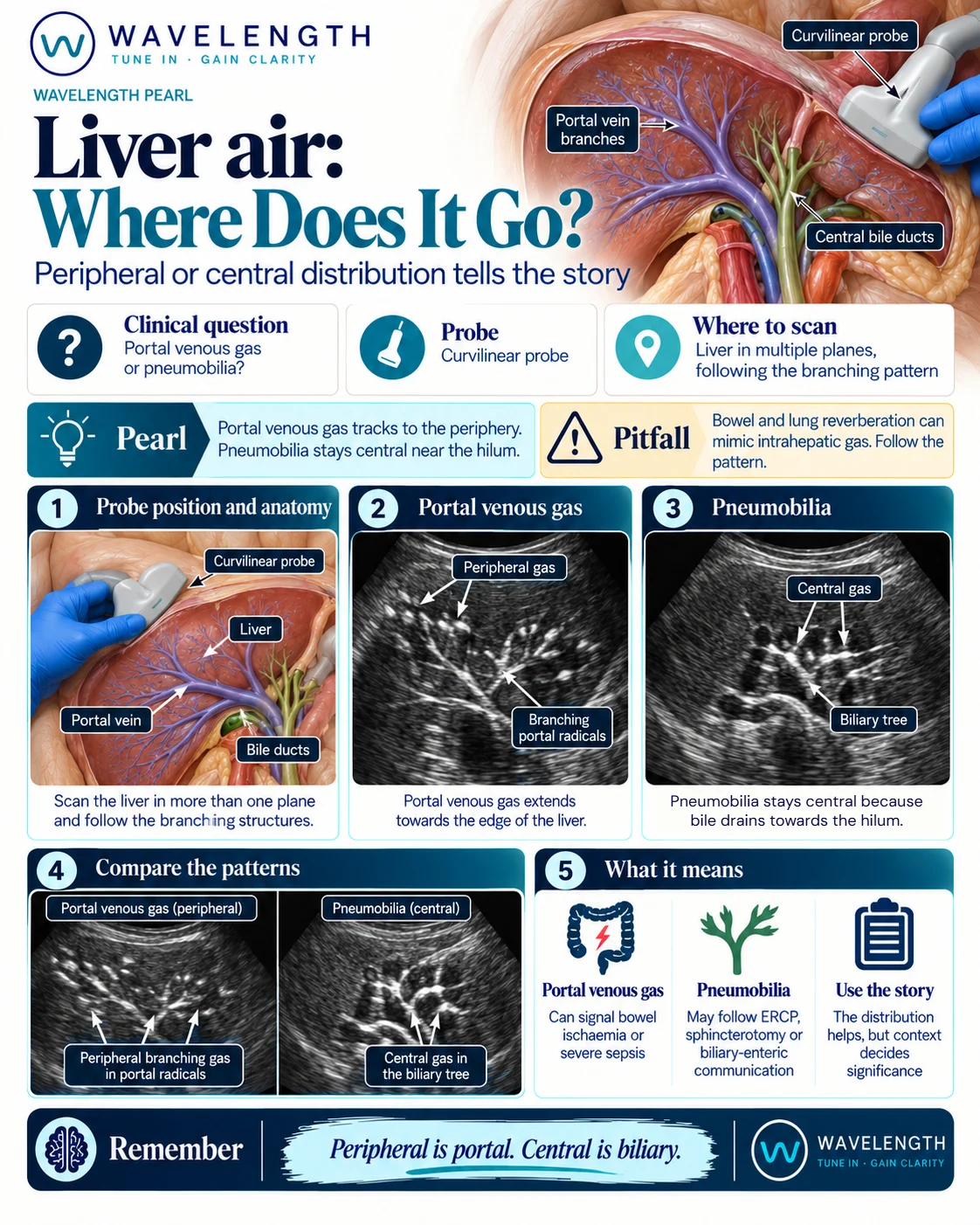 Wavelength Pearl: liver air. Portal venous gas reaches the edge of the liver. Pneumobilia stays central near the hilum.
