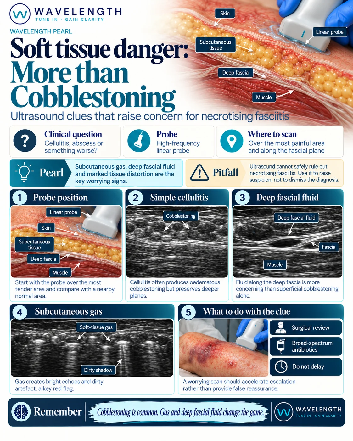 Wavelength Pearl: soft tissue danger. Cobblestoning is common. Fluid along the deep fascia and soft tissue gas raise concern for necrotising fasciitis.