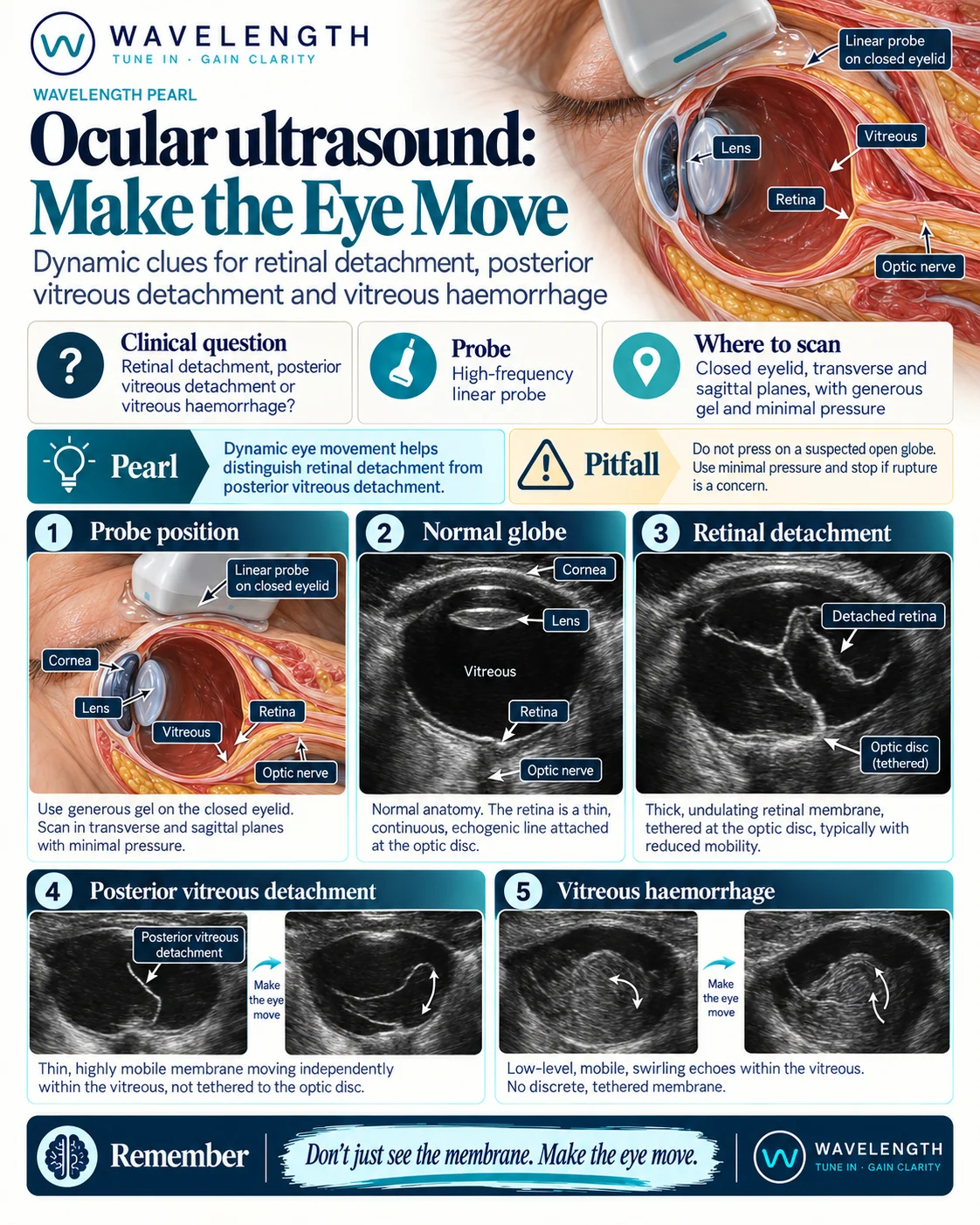 Wavelength Pearl: ocular ultrasound. Make the eye move. A retinal detachment is tethered at the optic disc. A posterior vitreous detachment moves freely.