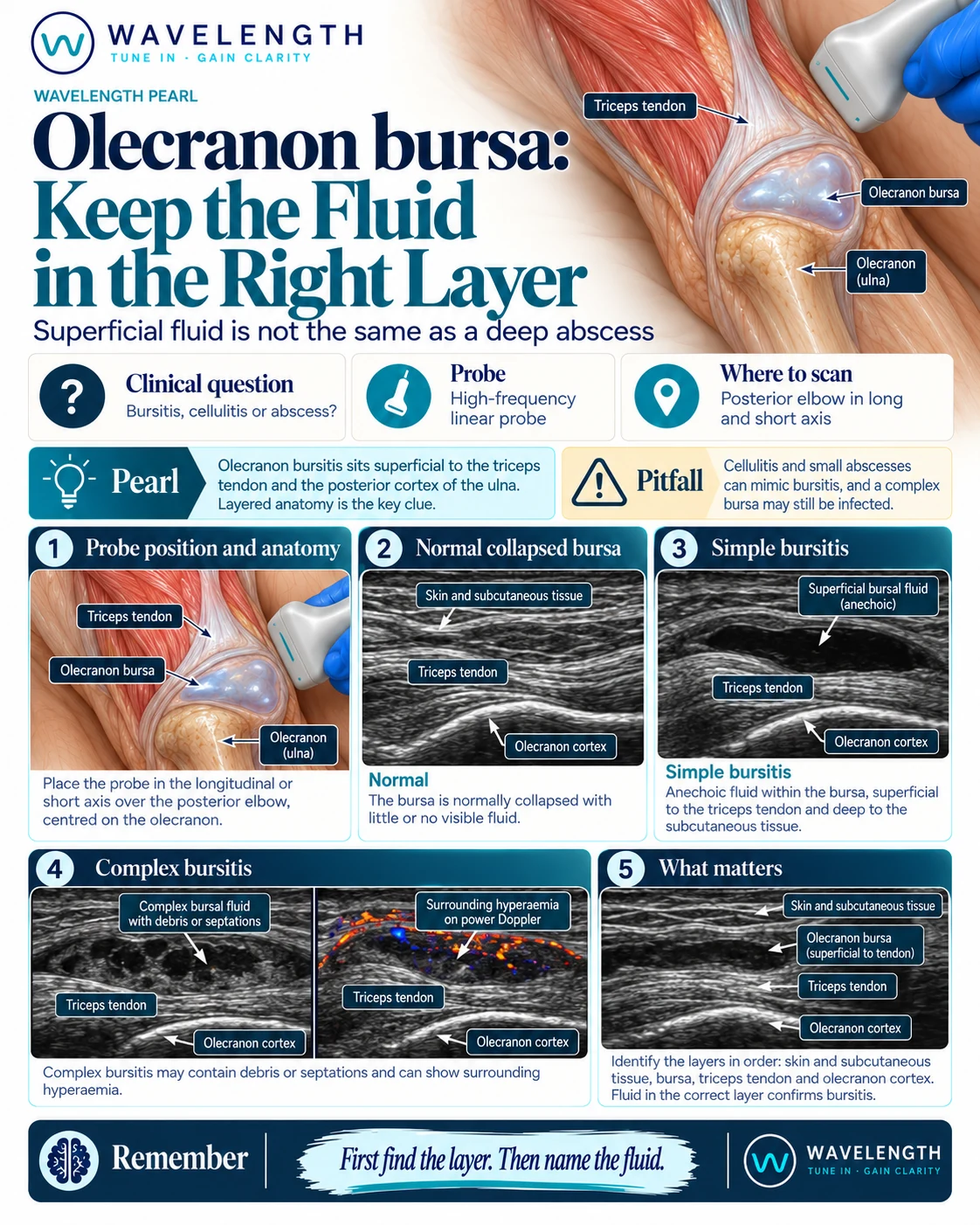Wavelength Pearl: olecranon bursa. A collapsed normal bursa, a simple bursitis with clear fluid, and a complex bursitis with debris and surrounding hyperaemia.