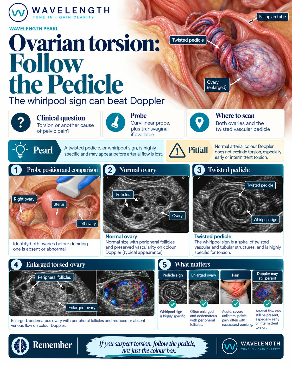 Wavelength Pearl: ovarian torsion. Compare both ovaries, look for an enlarged oedematous ovary and follow the pedicle for a whirlpool sign.