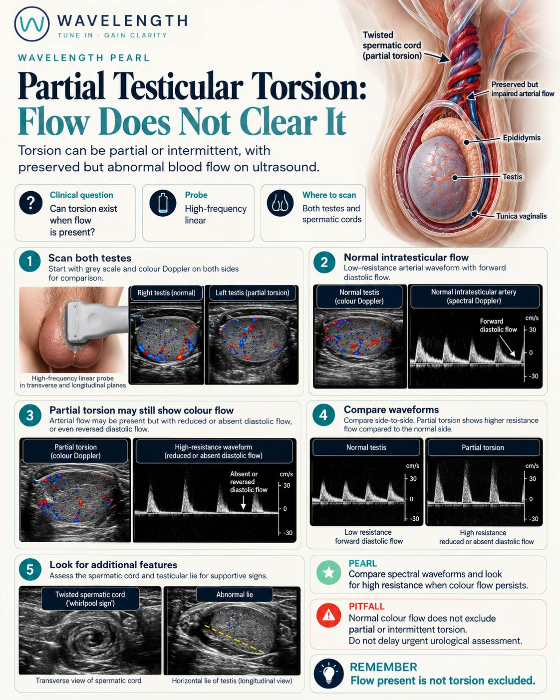 Wavelength Pearl: partial testicular torsion. Colour flow persists, but the arterial waveform shows high resistance, with lost or reversed diastolic flow, compared with the normal side.