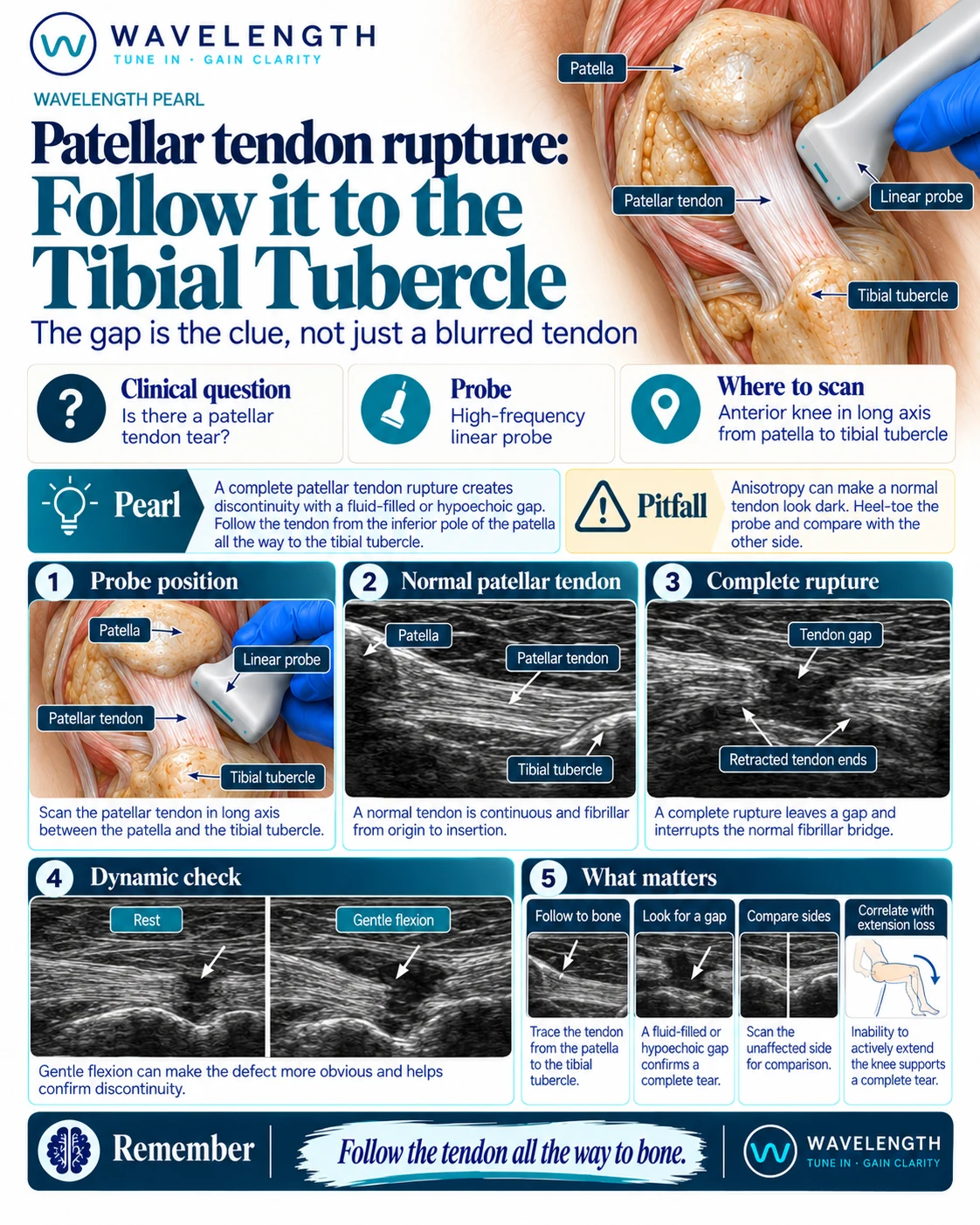 Wavelength Pearl: patellar tendon rupture. A continuous fibrillar tendon from patella to tibial tubercle, and a complete rupture with a gap and retracted ends.