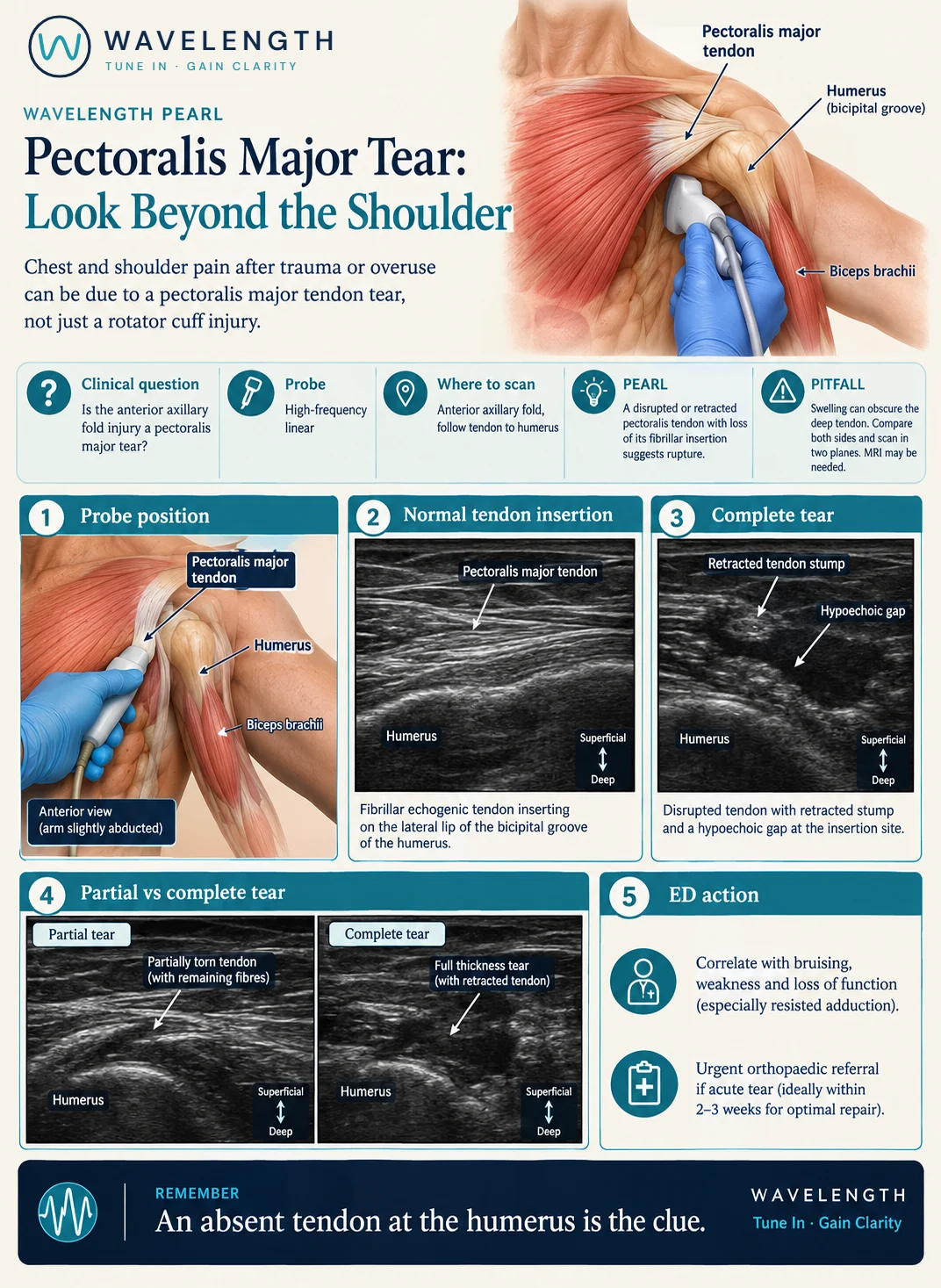 Wavelength Pearl: pectoralis major tear. The normal tendon inserting on the humerus, a complete tear with a retracted stump, and a partial tear.