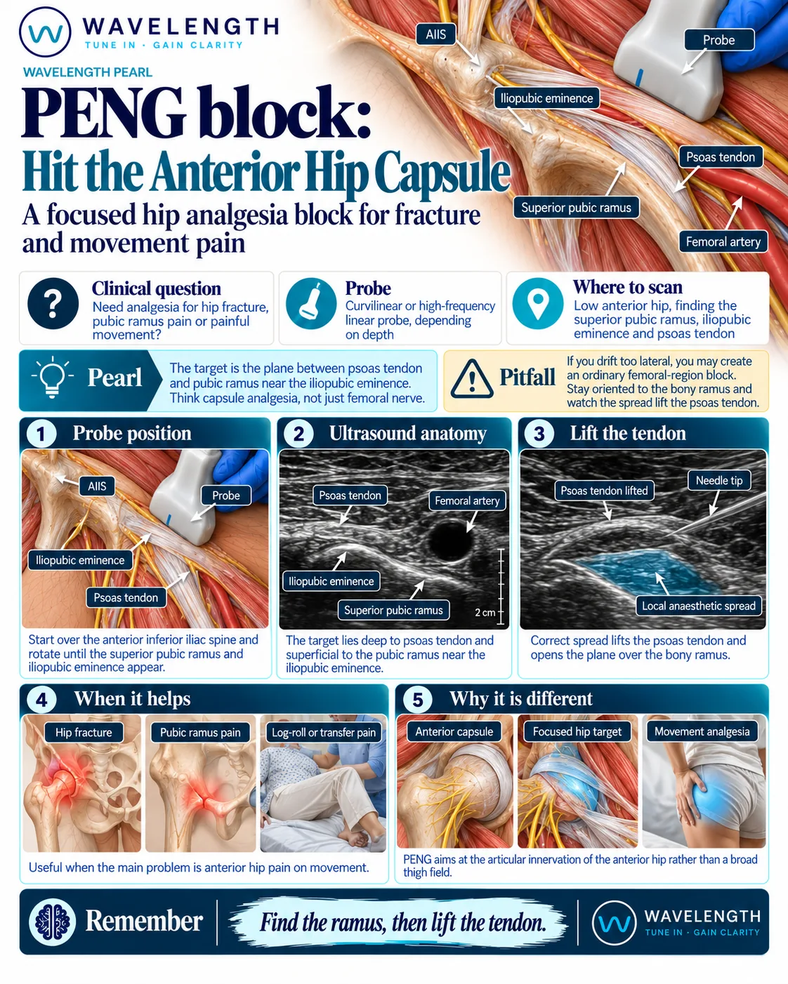 Wavelength Pearl: PENG block. Find the superior pubic ramus and iliopubic eminence, then lift the psoas tendon with local anaesthetic.