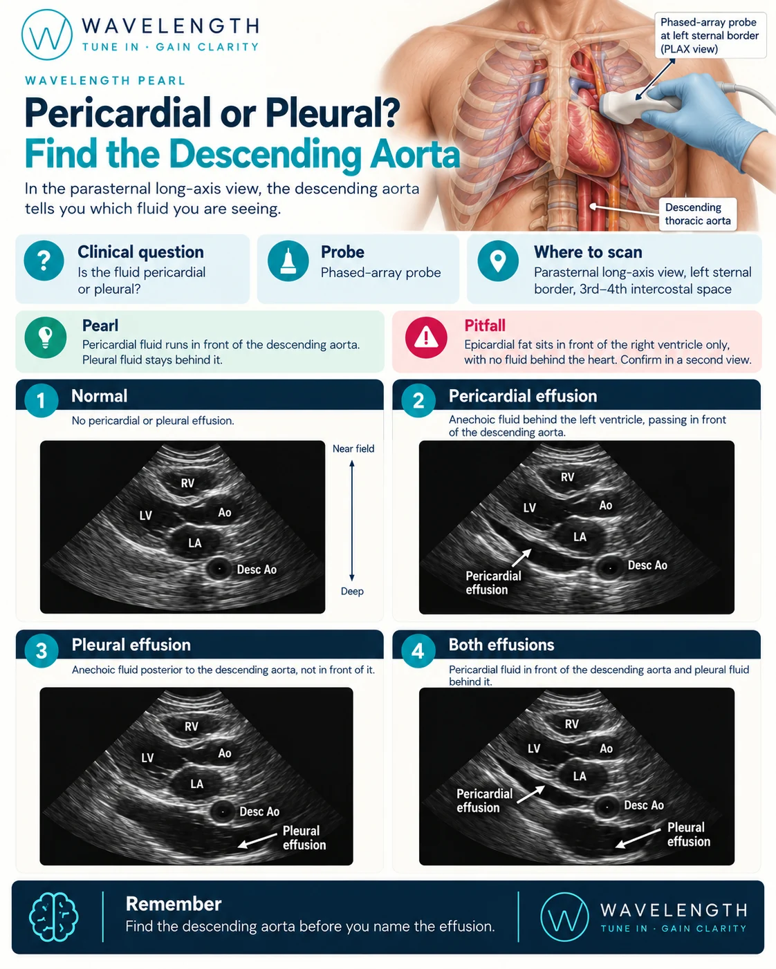 Wavelength Pearl: pericardial or pleural effusion. In the parasternal long-axis view, pericardial fluid lies anterior to the descending aorta and pleural fluid lies posterior to it.