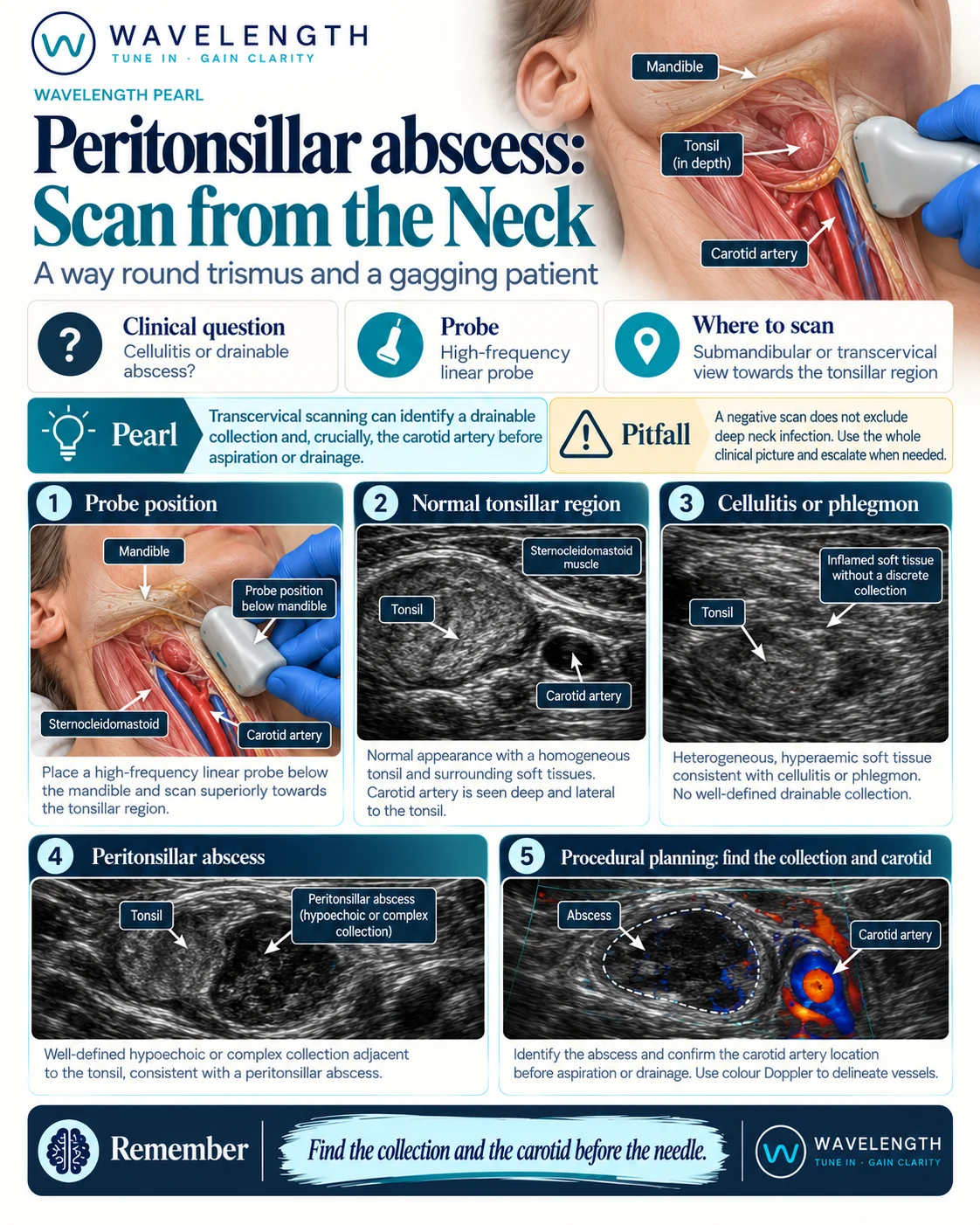 Wavelength Pearl: peritonsillar abscess. Scan from below the jaw to find the collection and the carotid artery before aspiration.