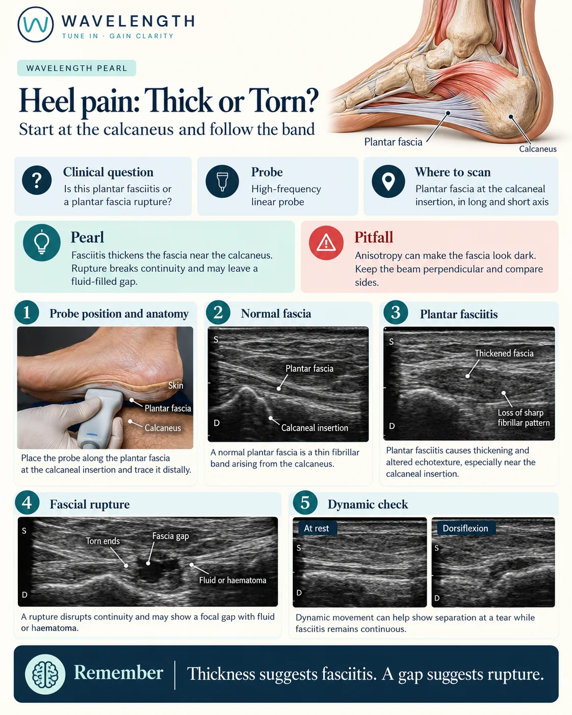 Wavelength Pearl: heel pain. A thin normal plantar fascia, a thickened fascia in fasciitis, and a fascial gap in rupture.