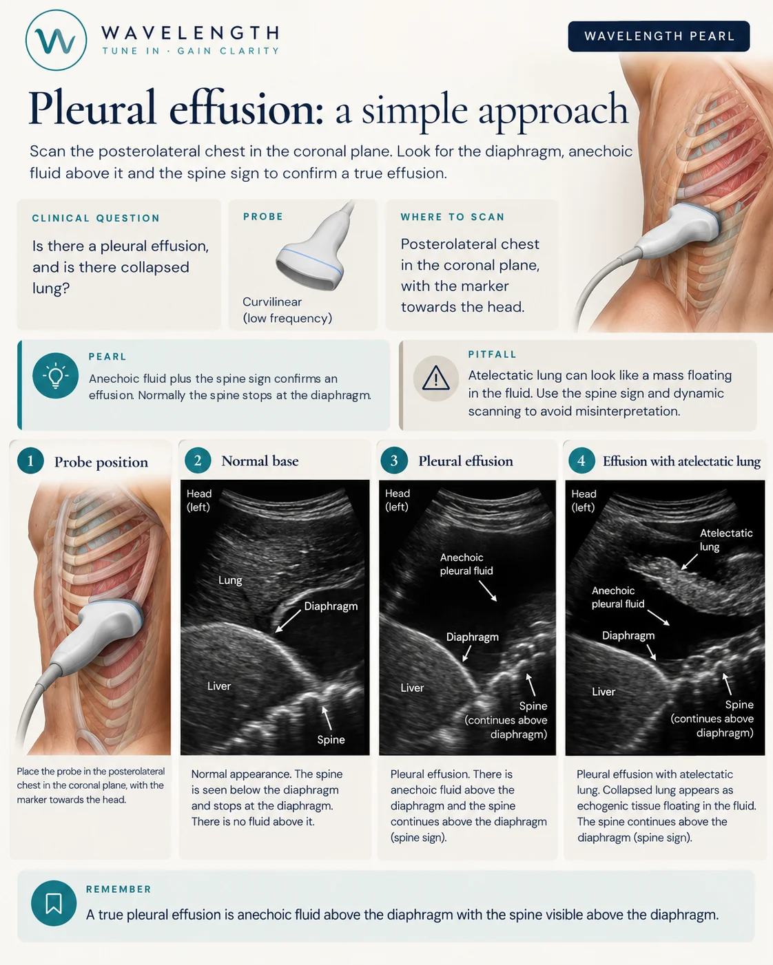 Wavelength Pearl: pleural effusion. Scan the posterolateral chest in the coronal plane and look for the spine above the diaphragm.
