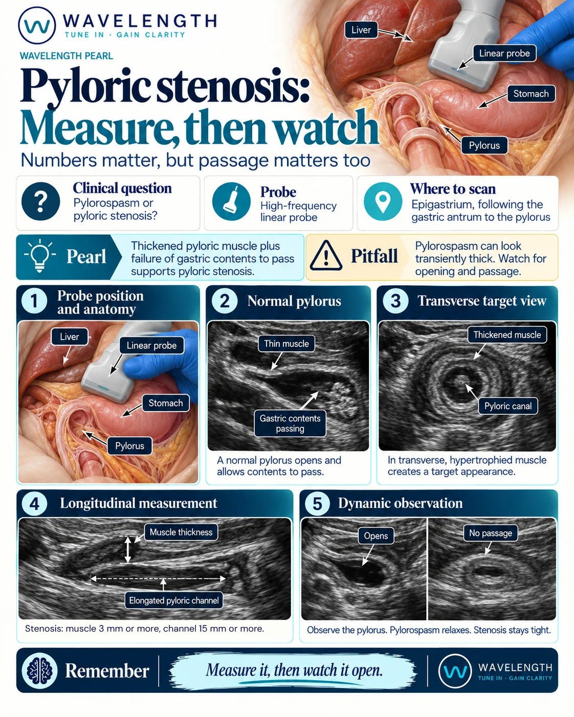 Wavelength Pearl: pyloric stenosis. A thick pyloric muscle and a long channel that does not open.