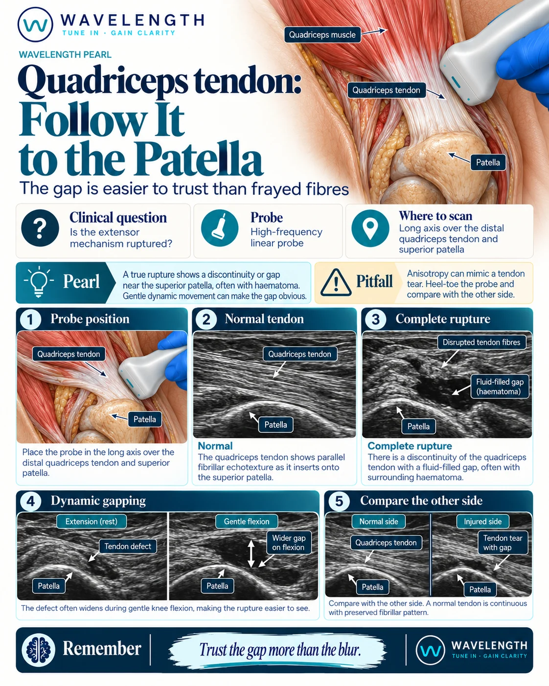 Wavelength Pearl: quadriceps tendon. Scan in long axis to the superior patella, look for a gap, and add gentle flexion.