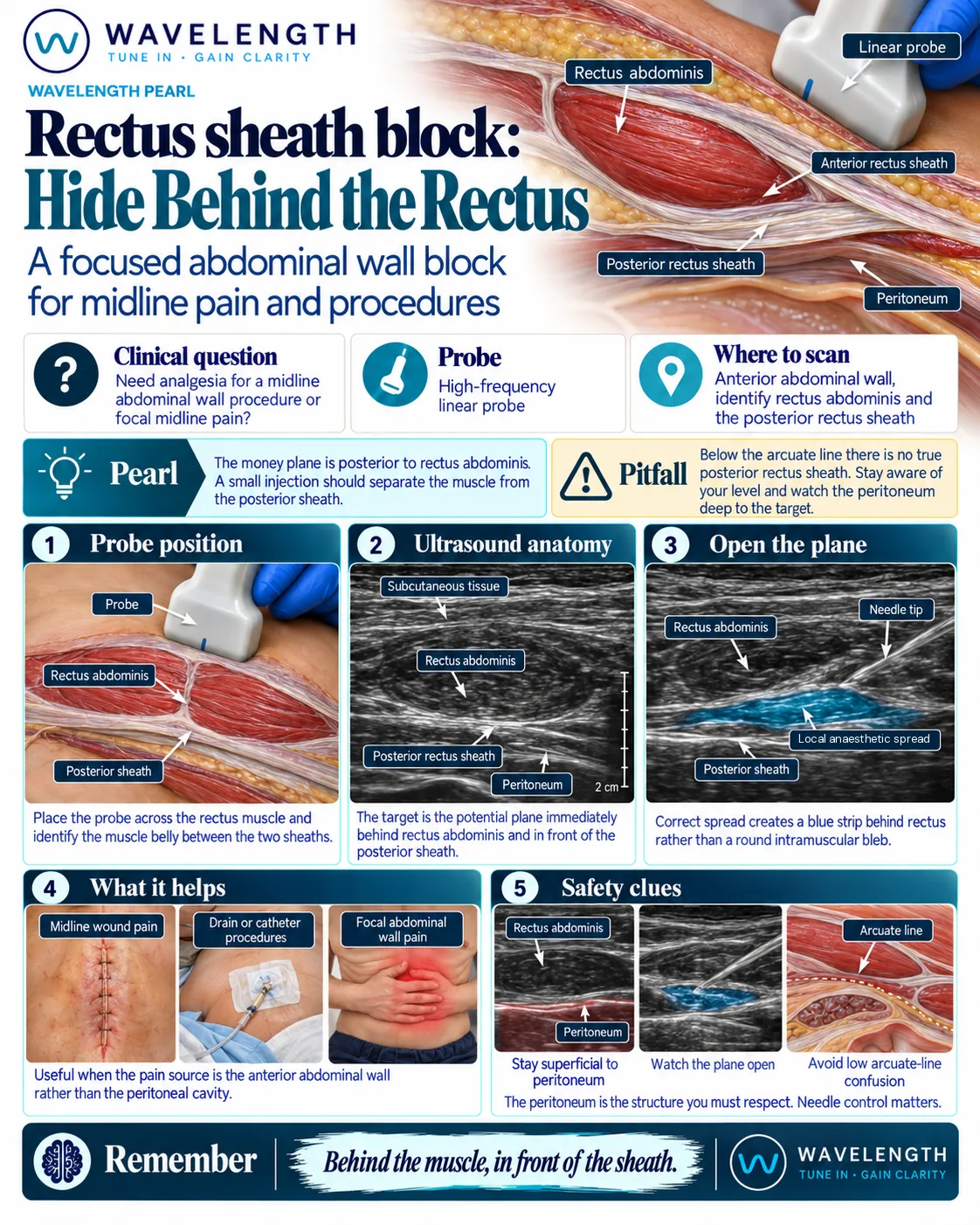Wavelength Pearl: rectus sheath block. Place the local anaesthetic behind rectus abdominis, in front of the posterior rectus sheath.