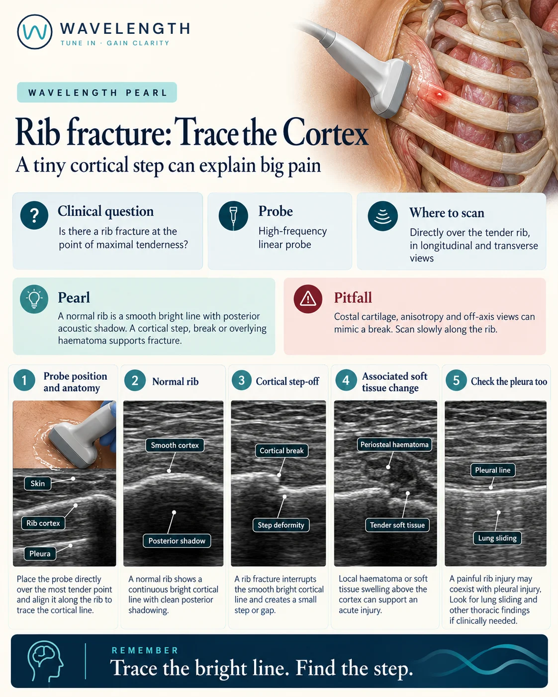 Wavelength Pearl: rib fracture. A smooth cortex, a cortical step, a haematoma over the rib, and lung sliding beneath it.