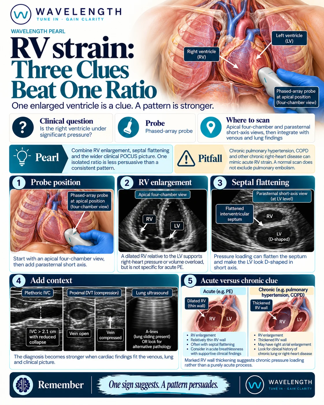 Wavelength Pearl: RV strain. Combine RV enlargement, septal flattening and venous and lung findings.