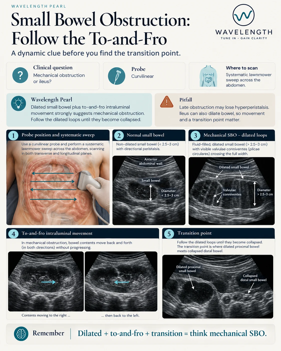 Wavelength Pearl: small bowel obstruction. Dilated loops with to-and-fro movement suggest mechanical obstruction.