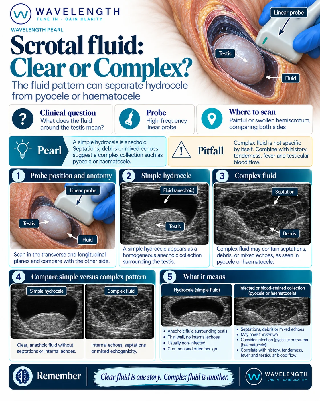 Wavelength Pearl: scrotal fluid. A simple hydrocele around the testis, and complex fluid with septations and debris.