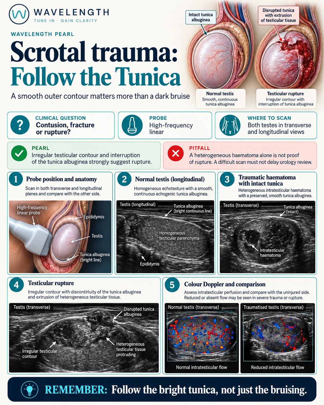 Wavelength Pearl: scrotal trauma. A normal testis with a smooth tunica, a haematoma inside an intact tunica, and rupture with a broken tunica and an irregular outline.