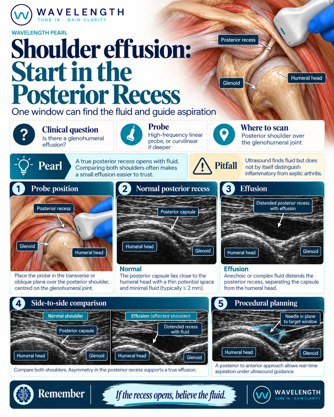 Wavelength Pearl: shoulder effusion. Scan the posterior recess, compare both sides, and plan aspiration in plane.