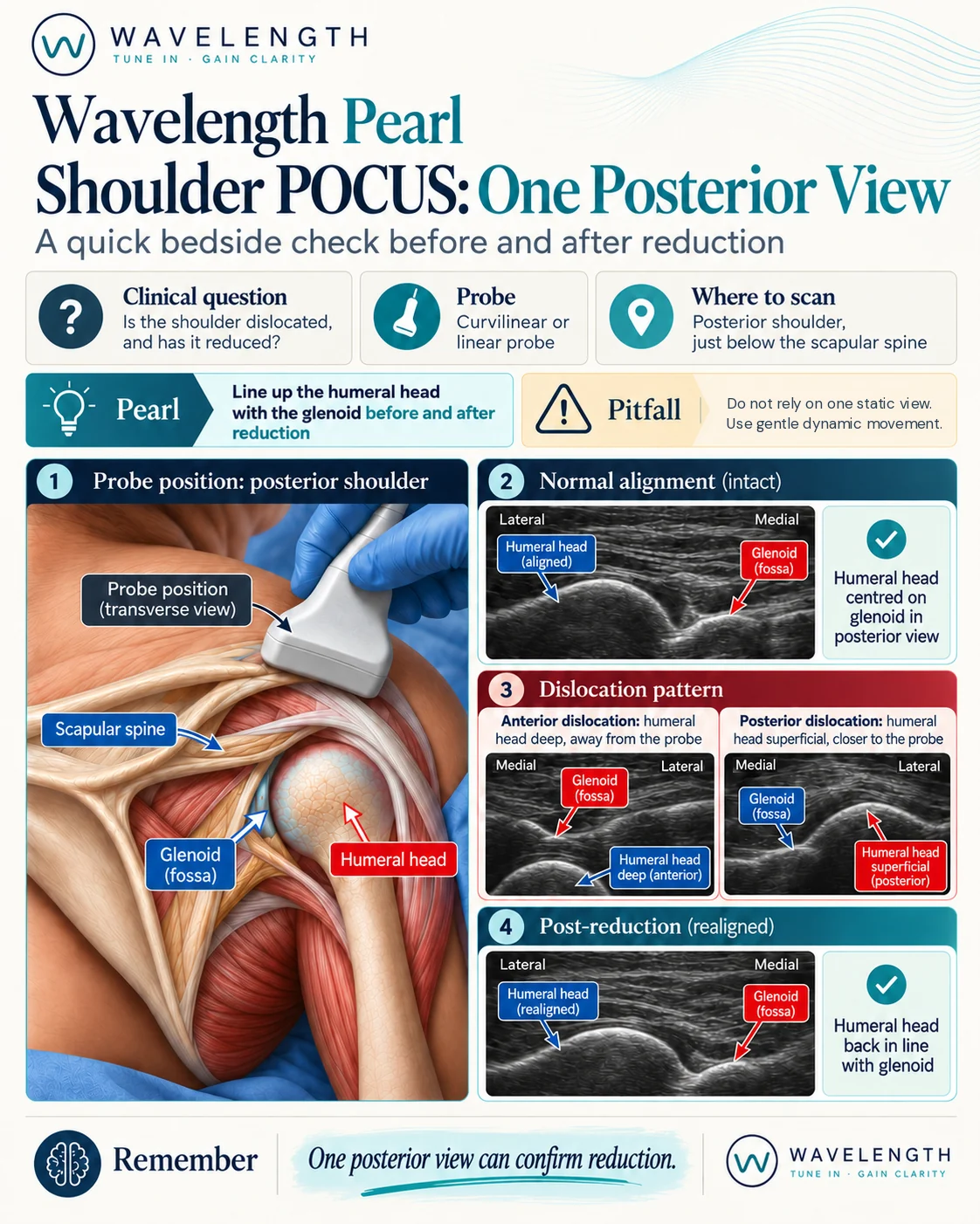 Wavelength Pearl: shoulder POCUS. One posterior transverse view shows alignment before and after reduction.
