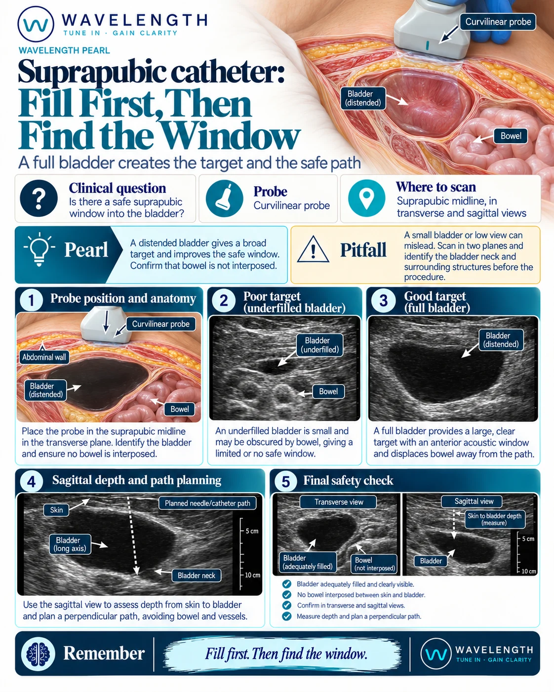Wavelength Pearl: suprapubic catheter. A full bladder gives a broad target and a safe window with no bowel in the path.
