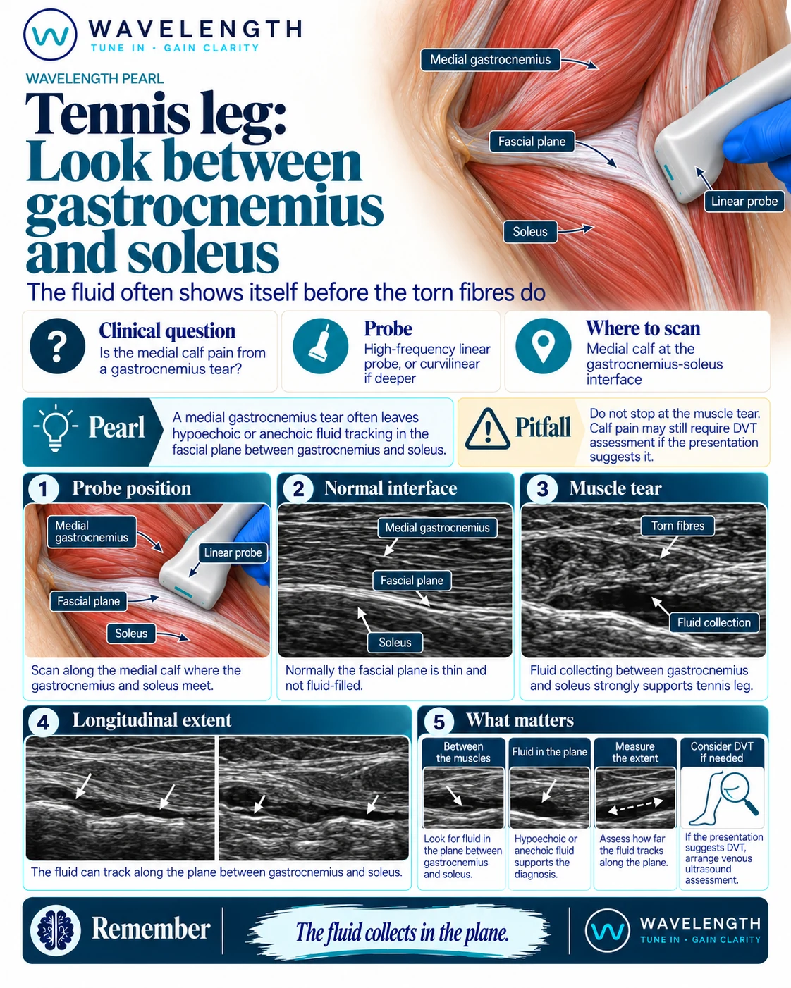Wavelength Pearl: tennis leg. The normal thin fascial plane between medial gastrocnemius and soleus, torn fibres with fluid in the plane, and the length of the collection.